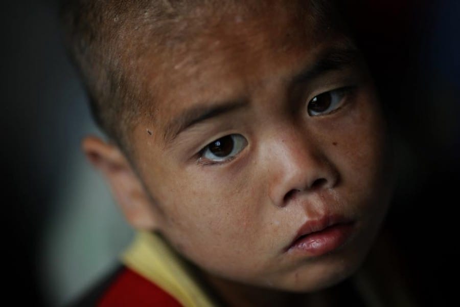 Anak yang diduga menderita gizi buruk Anak yang diduga menderita gizi buruk