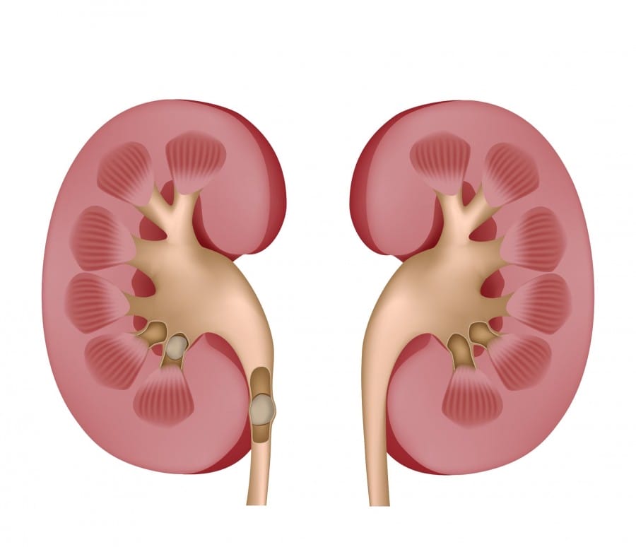 6 Gejala Yang Sering Dialami Penderita Batu Ginjal