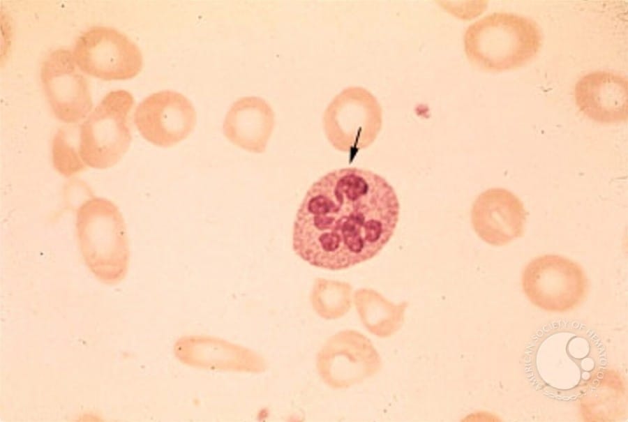 hematology.org