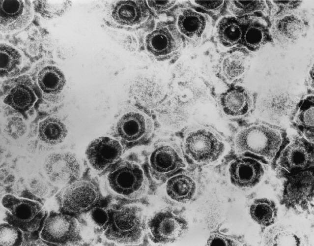 virus herpes simplex