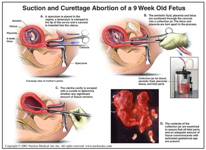 Dilarangnya Aborsi dalam Islam