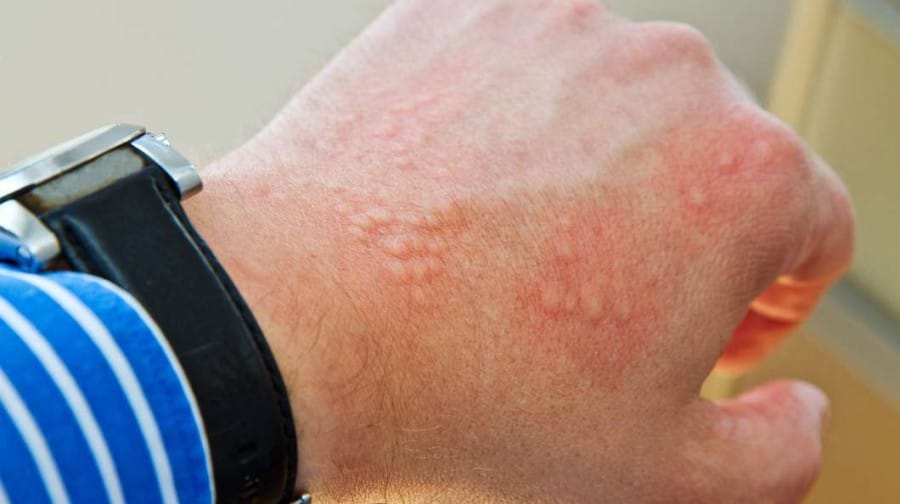penyebab alergi dari kulit