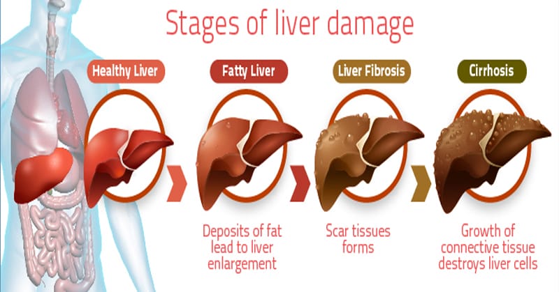 Penyakit liver |Pict by. thescienceofeating.com